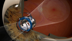 Illustration of an eye with the implantable telescope 