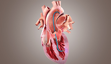 Diagram showing a cut-away of a heart that demonstrates CardiAMP therapy.